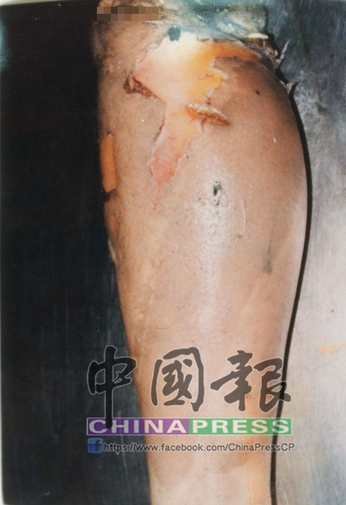 死者其中一段小腿殘肢上，清晰可見兇手切割屍體時留下的刀傷，由於殘肢被發現時，已腐爛發臭，因此可看見屍蟲蠕動。 