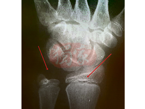 X光掃描顯示楊同學的左手腕骨頭斷裂（左箭頭）及骨折（右箭頭）。
