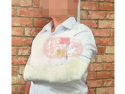 楊同學左手腕骨頭斷裂和骨折，必須打石膏。