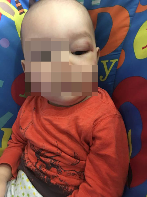 嬰兒的左眼紅腫，不像被玩具弄傷。