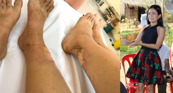 梁祖仪双腿三度灼伤。