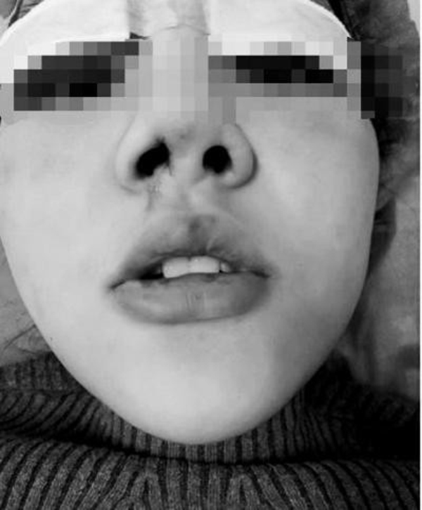 河南一名女大生隆鼻失敗,鼻孔變成一大一小。
