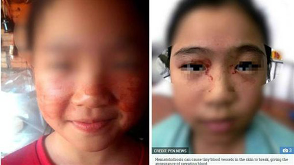 女童因讀書考試壓力大,臉上流出血汗。圖:互聯網