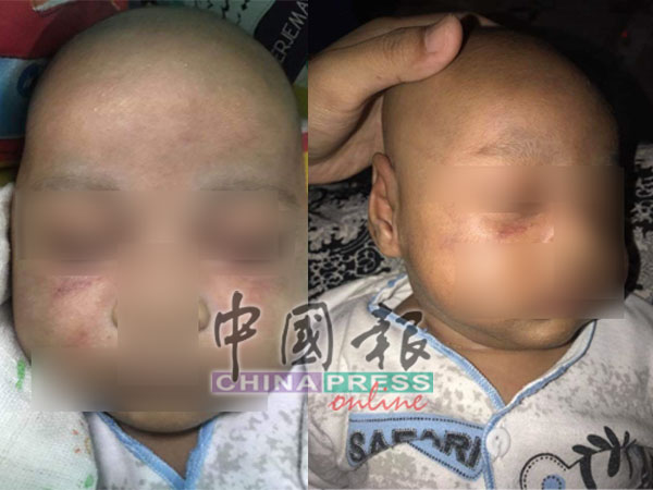 男婴脸上多处出现瘀青及嘴边出现伤痕。