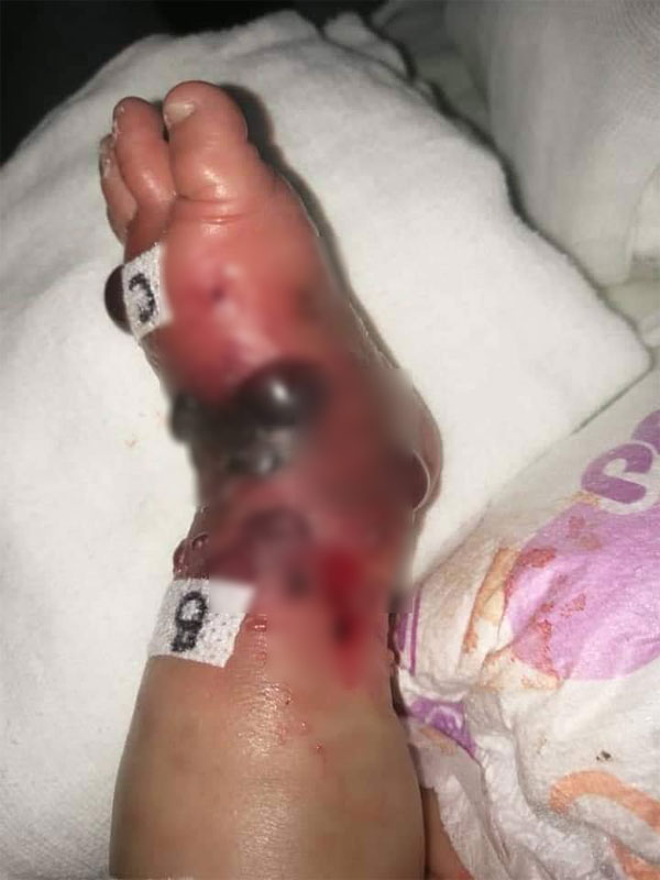男嬰腳部冒血泡、嚴重紅腫。