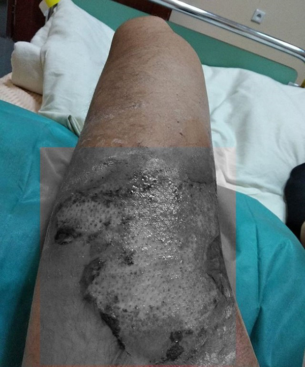 医生表示他右大腿皮肤坏死,且他的生殖器严重损伤,为三级烧伤。