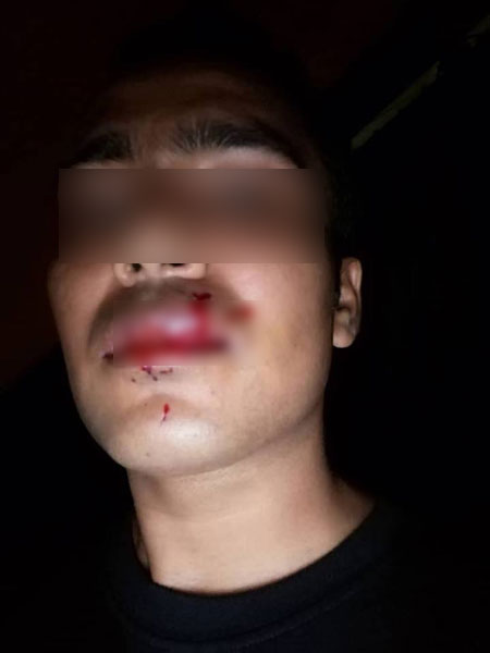 男子被Grab司机打伤嘴唇，送院后缝了6针。