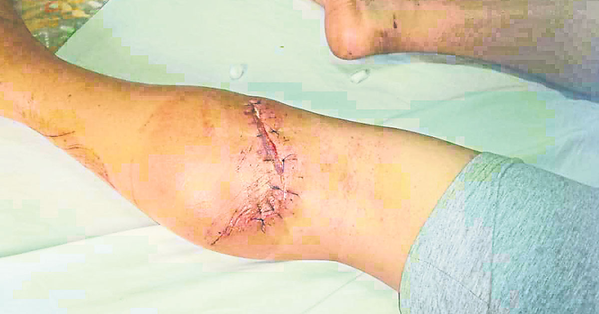 李再万右脚小腿被石头割伤，缝了十余针。