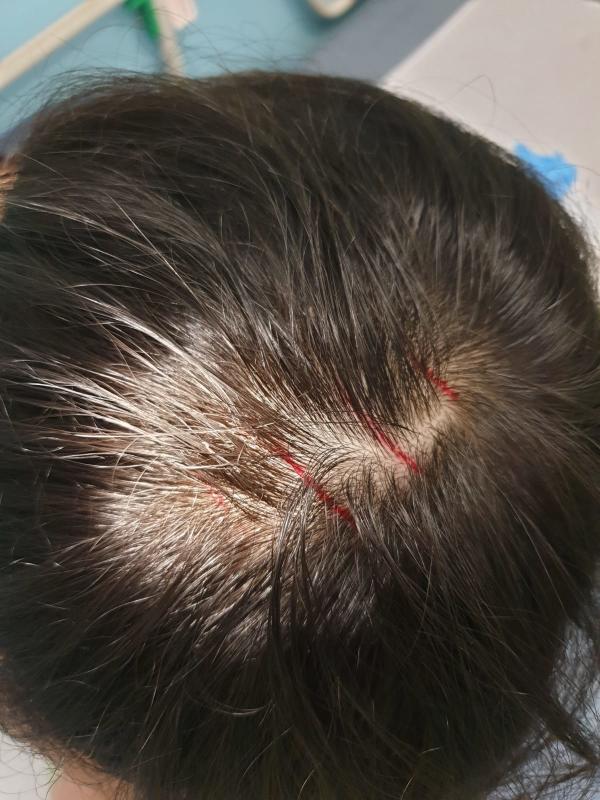 10岁男童的头上留下四道伤痕。（受访者提供）