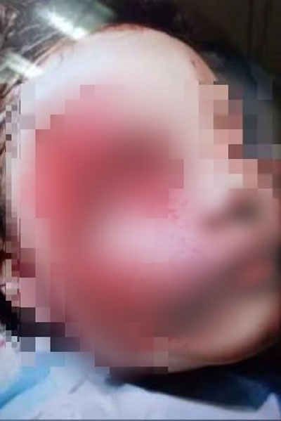 女童被比特犬咬至脸部重伤。