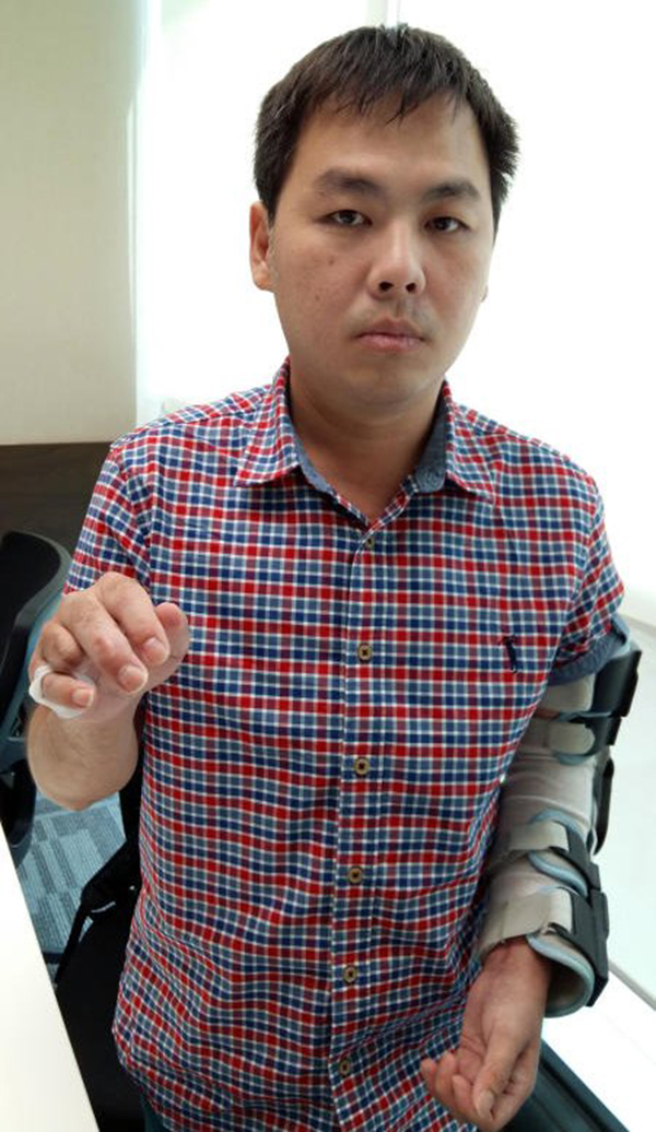 郑子洋的右手无名指，在车祸后断落。
