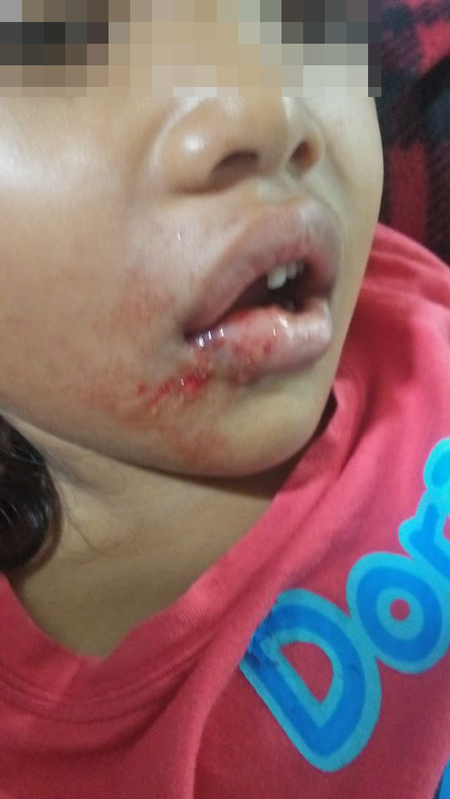 女童的脸颊和嘴巴都受伤，牙齿也被撞断一颗。