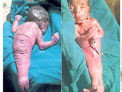 印度一名初生嬰兒，天生雙腳相連。