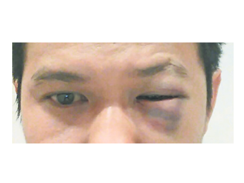 修車員的左眼遇襲後瘀青，臉部出現紅腫。 