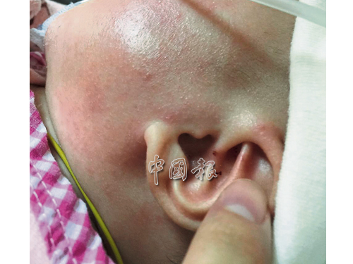郭美仪女儿的脸上、小手都有被蚊子叮过的痕迹，耳朵更因此被捉伤。