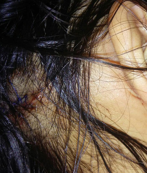 女子被匪徒推入溝渠，導致頭破血流，送院縫了7至8針。 
