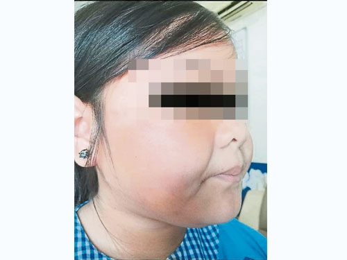 女童臉頰微腫，有被掌摑的痕跡。