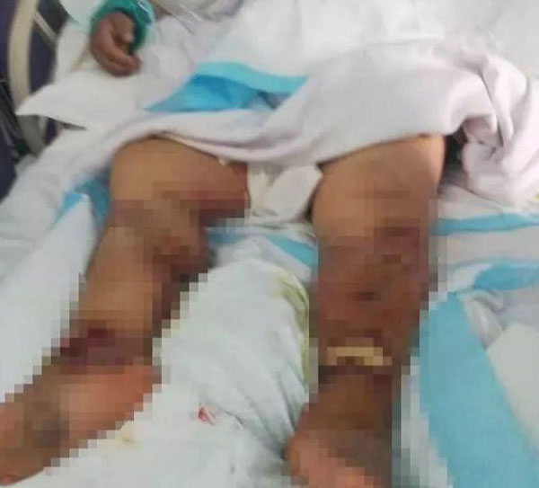 女子入院第二天出現下肢腫漲的情況。