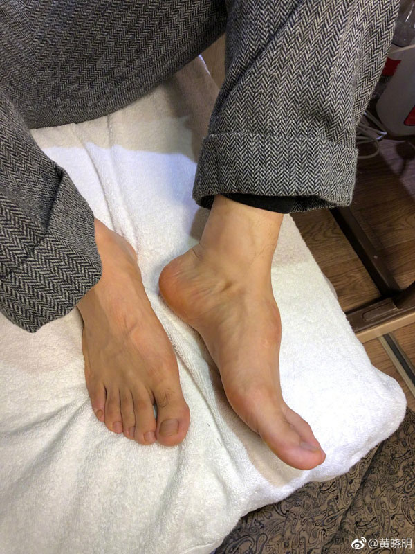 黄晓明因为当年事故后，脚背已无法恢复原状。