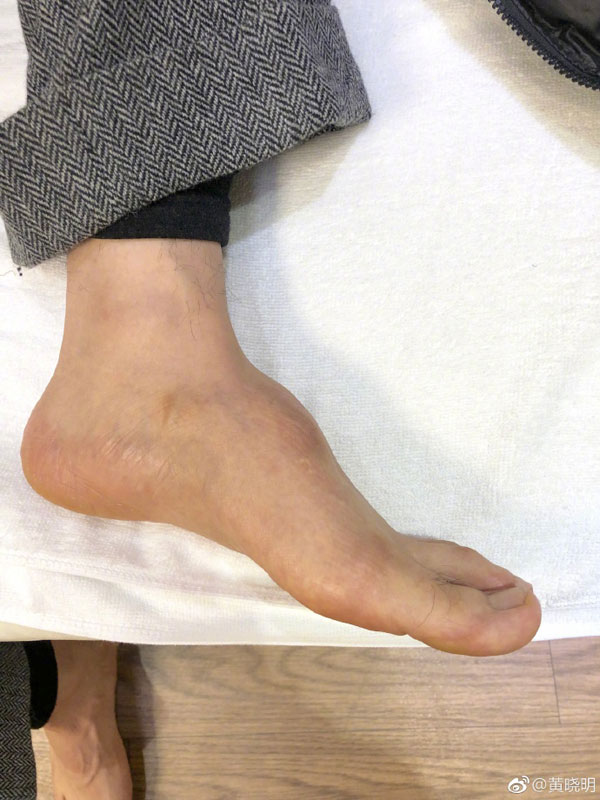 黄晓明因为当年事故后，脚背已无法恢复原状。