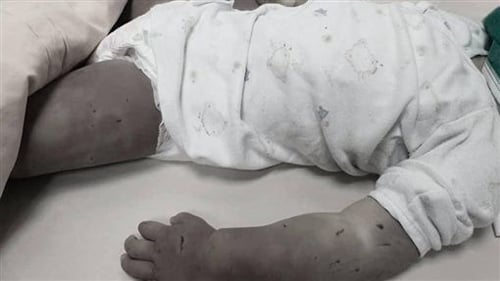 女童身上满是伤痕,还受有多处的小刀伤痕