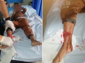 右脚被狗咬伤 5岁童入院缝针