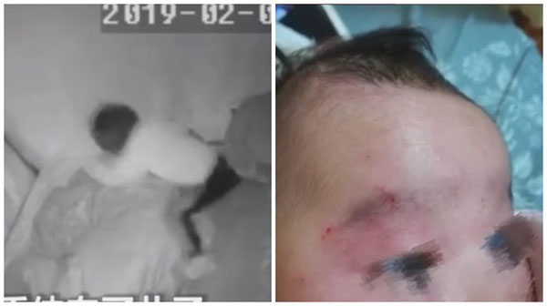 4岁女童（左）暴打未满月堂弟，导致堂弟（右）脸青鼻肿。
