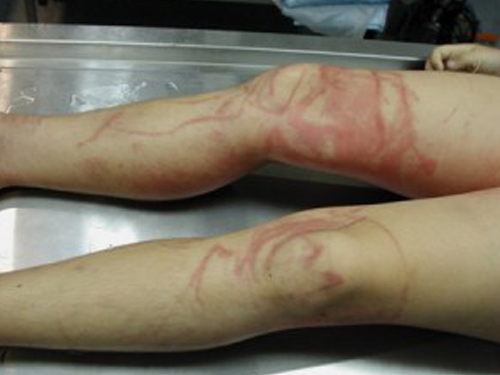 澳洲一名女孩腿部被“箱形水母”蛰伤，她是少数幸存者。（图取自网络）