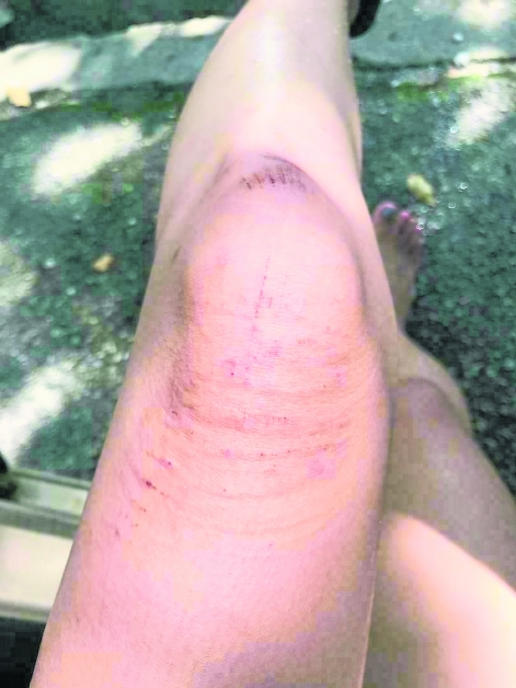 李晓玲的左脚误踩入已损坏的铁盖后，导致膝盖损伤。