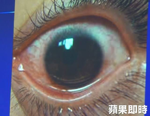 陈女的左眼出现结膜充血。