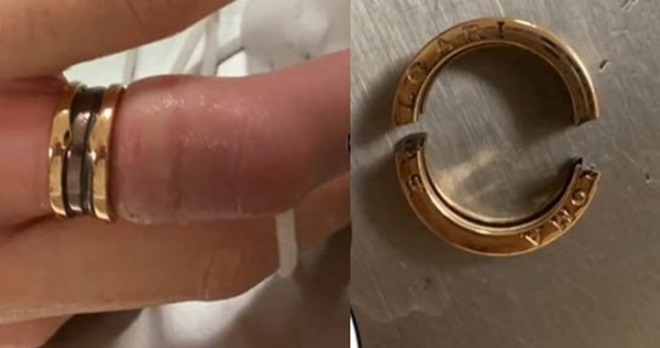 女子被戒指卡住的手指（左），以及被锯断后的戒指（右）。