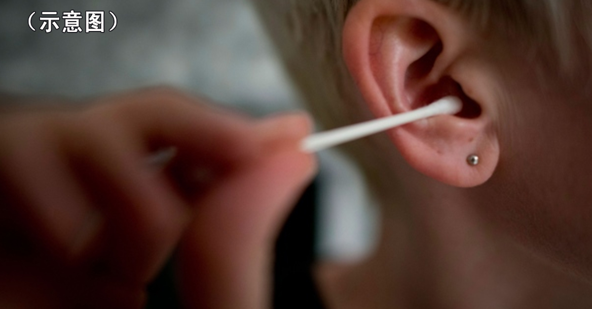 英国一名男子，因用棉花棒清洁耳朵，导致受细菌感染，需要医治5年才康复。图为示意图。