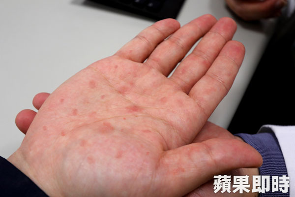 李先生手掌红肿，确诊为梅毒二期。