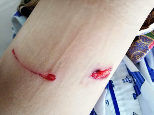 女童被狗咬后，腿部出现两个血洞般的伤口。