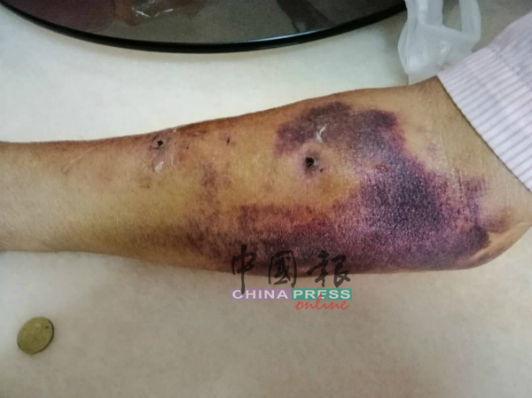 一名肾病患展示在洗肾过程中，遭折腾到瘀伤的手臂。
