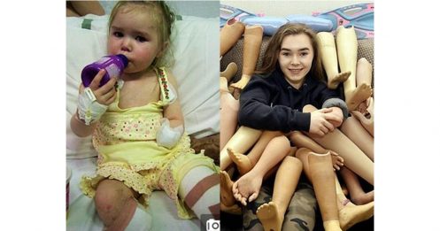 13年前患脑膜炎截肢保命 残疾少女献爱心 捐25对义肢