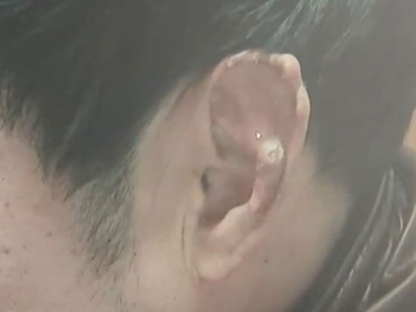 耳朵上的结石。