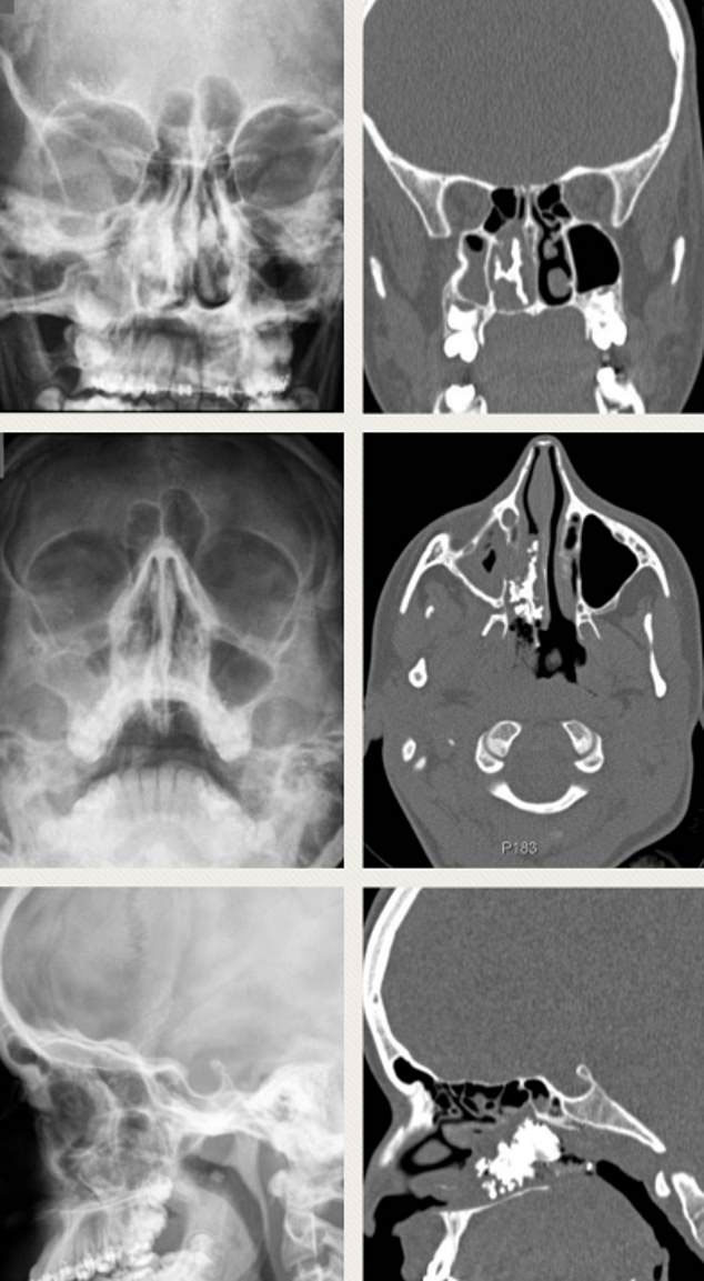 X光照片显示，少女的鼻腔卡了一块超大的“鼻石”。