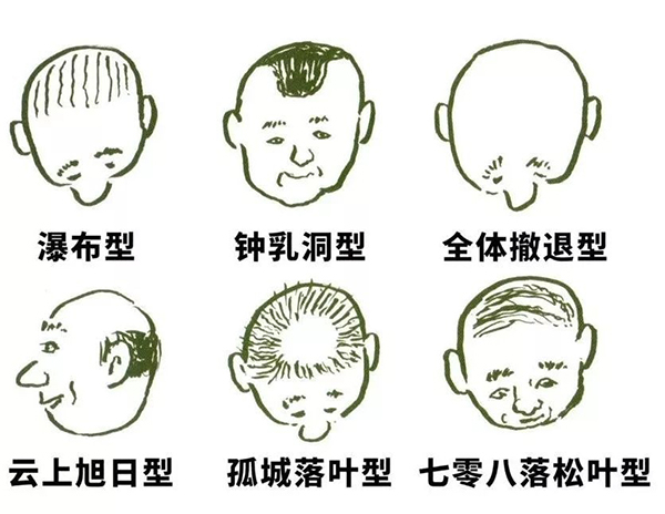 协会把各类型的秃头做了分类。