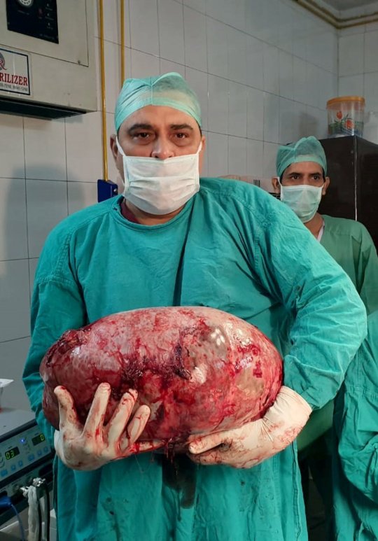 医生把巨型子宫瘤抱在手上。