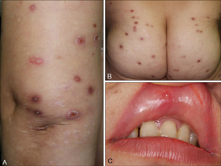 白赛病是一种特殊的自体免疫疾病，会让口腔及生殖道，出现红疹、溃烂。