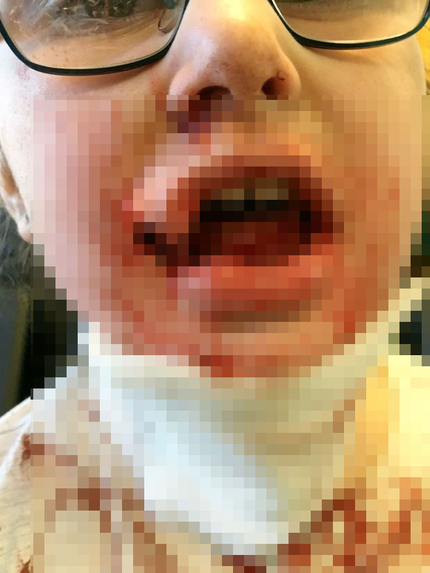 杨格的上下嘴唇几乎被撕裂，伤可见骨。