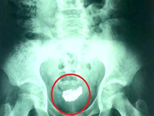 X光片显示，磁珠堆积在男童膀胱内。