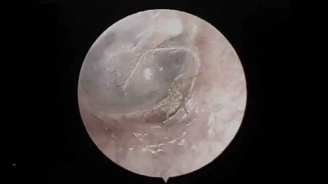 透过内视镜，发现小李耳道深处有只类似蜘蛛的活体生物，并已在周围结了网。