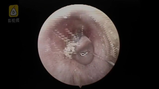 医师缓缓注入生理食盐水后，顺利将蜘蛛赶出。