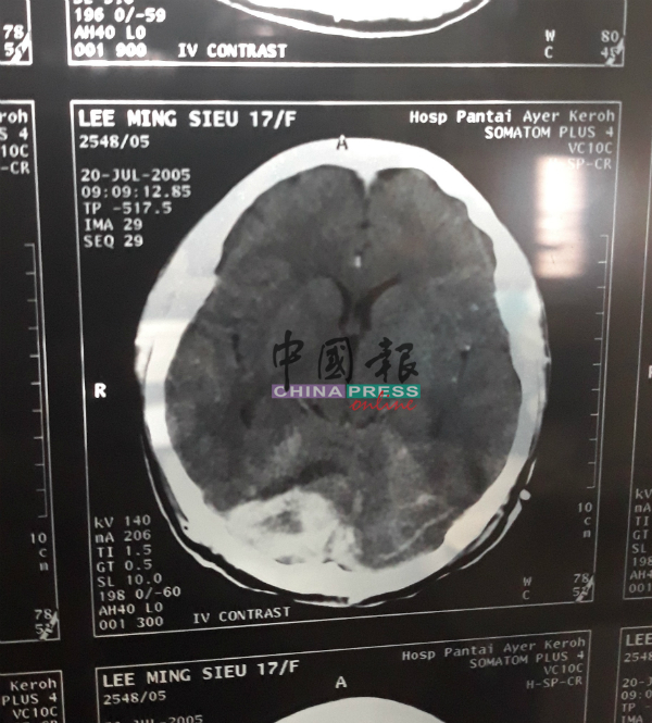 2005年时的电脑断层扫描报告显示黎明秀脑部后方出现一块肿瘤。