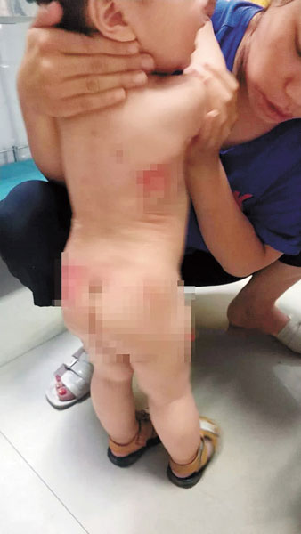 孩子的背部和臀部都被烫伤。