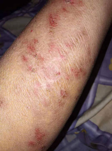 一名患者展示身体出现皮疹，身体很痛。（照取自互联网）