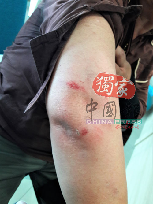 邓玉萍因摔倒在地及被拖拉一段距离，以致右手臂擦伤。