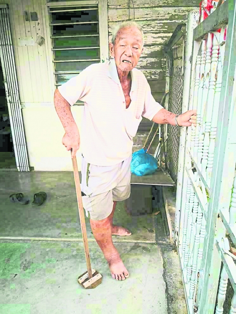 来自马口峇卡巴都村的丘祖青，手脚严重肿胀，目前已送往医院医治。